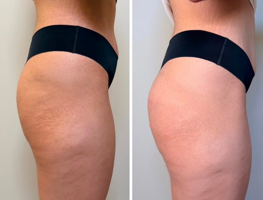 Resultado de harmonização de glúteos 1 — antes e depois
