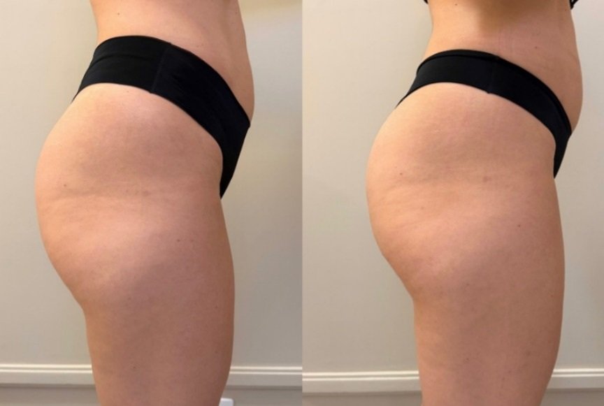 Resultado de harmonização de glúteos 3 — antes e depois