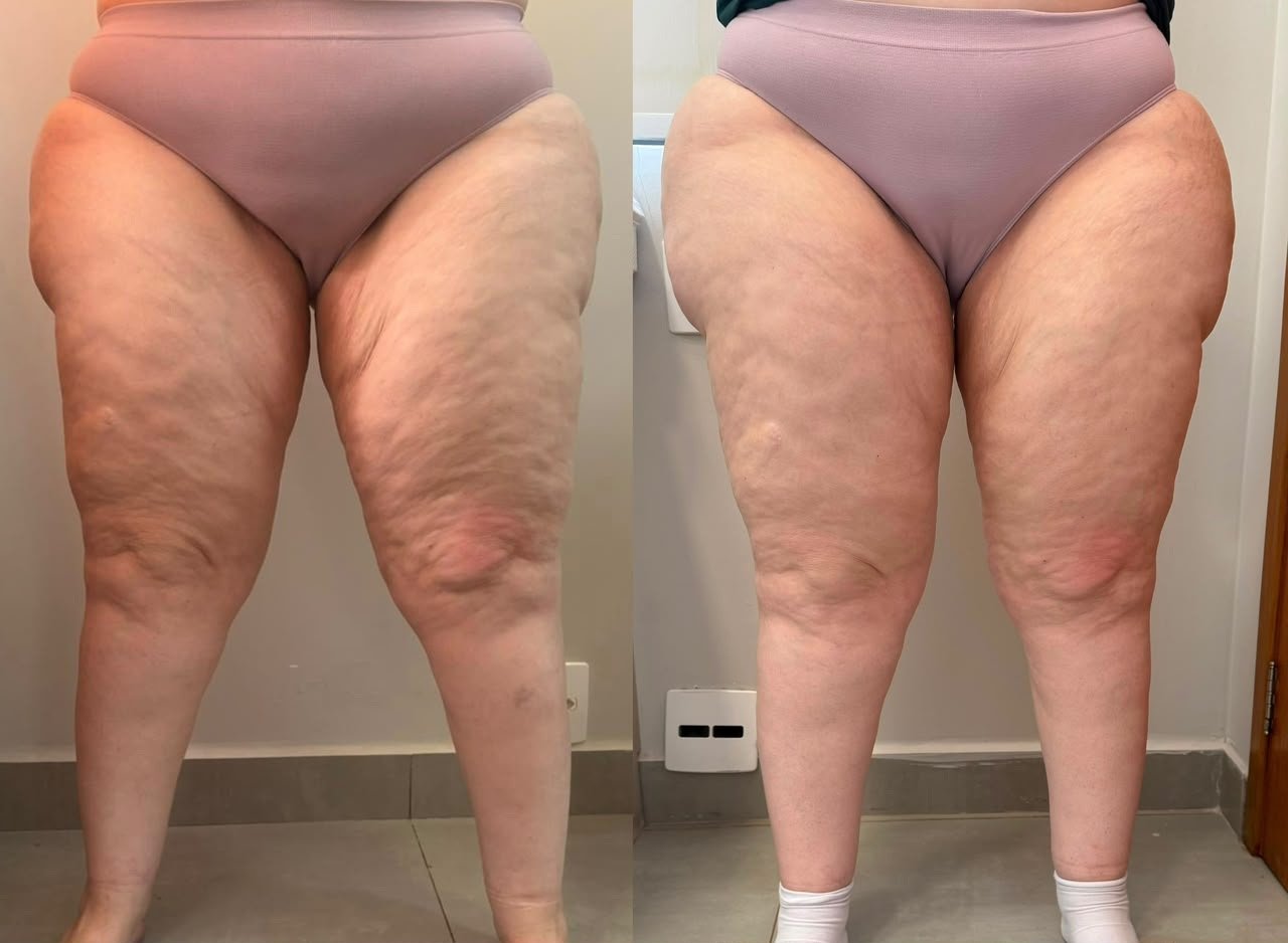 Resultado de lipedema 1 — antes e depois