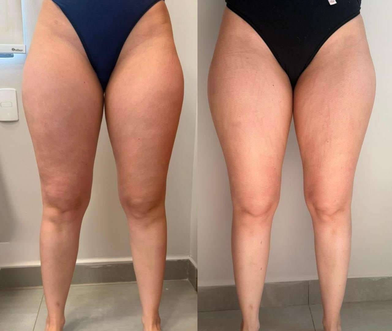 Resultado de lipedema 2 — antes e depois