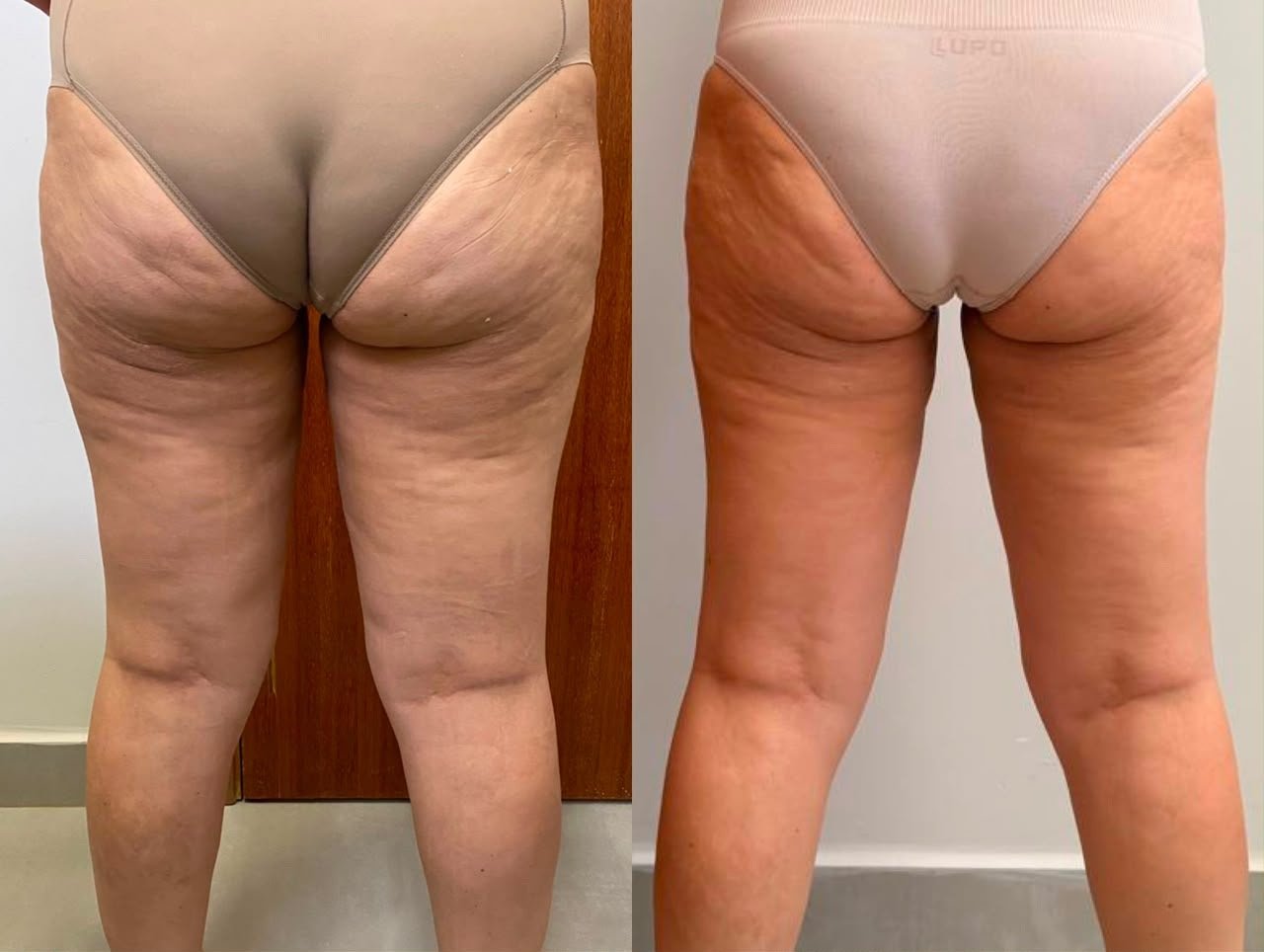 Resultado de lipedema 3 — antes e depois