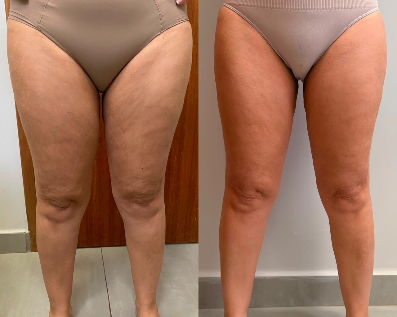 Resultado de lipedema 4 — antes e depois