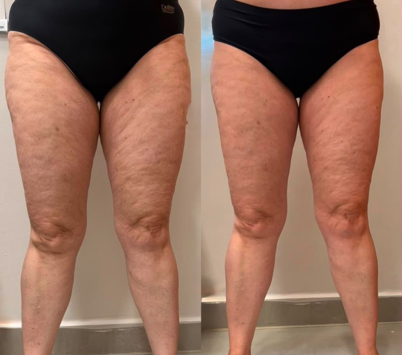 Resultado de lipedema 5 — antes e depois